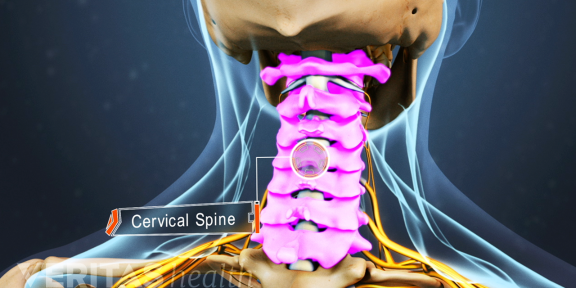 Vật lý trị liệu thoát vị đĩa đệm cột sống cổ Vật lý trị liệu thoát vị đĩa đệm cột sống cổ