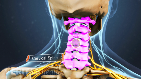Vật lý trị liệu thoát vị đĩa đệm cột sống cổ Vật lý trị liệu thoát vị đĩa đệm cột sống cổ