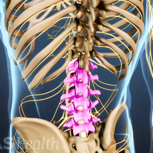 Vật lý trị liệu thoát vị đĩa đệm cột sống thắt lưng